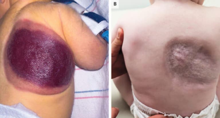 Lekarze ostrzegają przed nasileniem się gwałtownych reakcji immunologicznych!